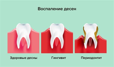 Разные методы и средства при лечении воспаления и кровотечения десен