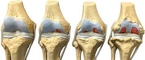 Разрушение хрящевой ткани коленного сустава