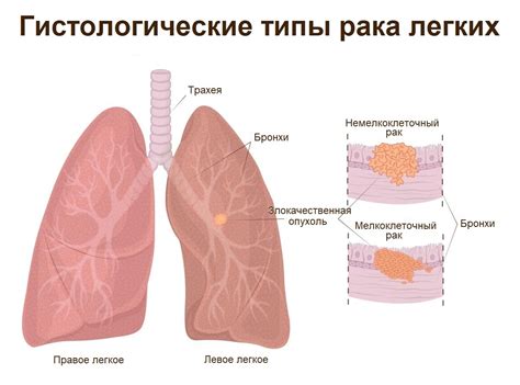 Рак легких и другие опухоли