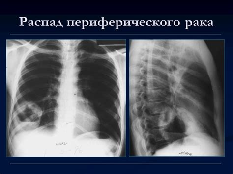 Ранняя стадия метастазов в легких