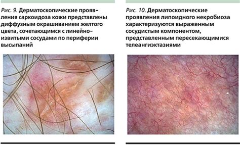 Распространенные заболевания, выявляемые при дерматоскопии