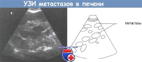 Распространенные методы диагностики метастазов