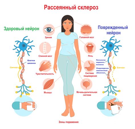 Рассеянный склероз и болевой синдром