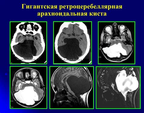 Расширение арахноидальной и пиа-материи