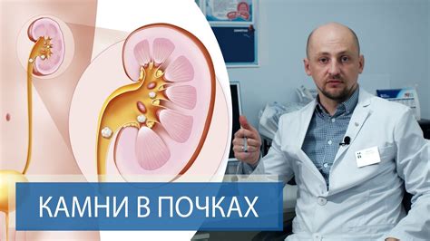 Реабилитация после лечения камней в почках