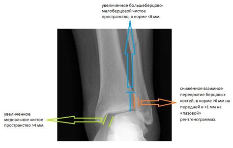 Реабилитация после разрыва межберцового синдесмоза