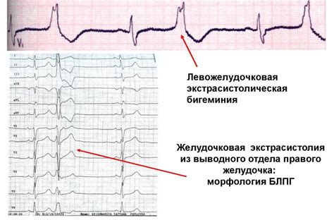 Редкая полиморфная желудочковая экстрасистолия