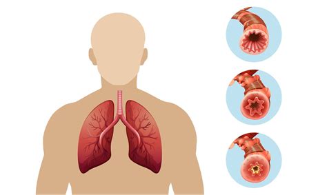 Резкое сужение бронхий: причины и симптомы