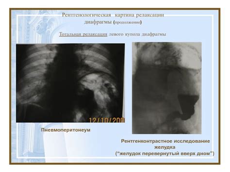 Рентгеновское исследование релаксации диафрагмы справа