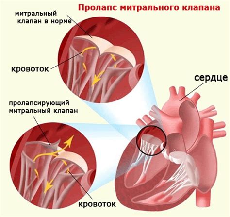 Риски и осложнения при пролапсе митрального клапана у взрослых