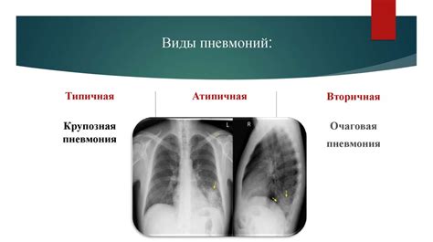 Роль Вильпрафена в лечении пневмонии