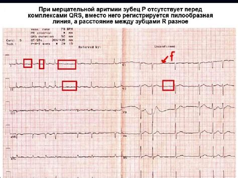 ССРЖ признаки ЭКГ у взрослого: основные черты и значение