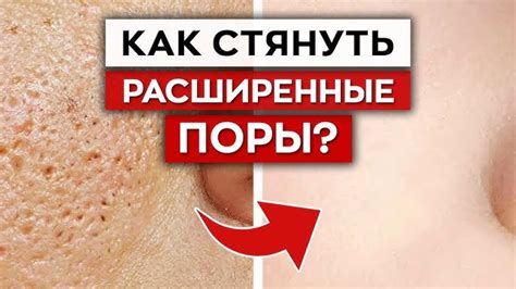 Самые эффективные способы избавиться от прыщей