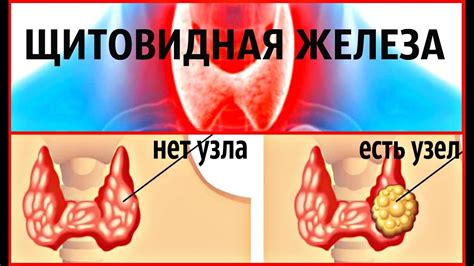 Связь между дефицитом йода и образованием узлов в щитовидке