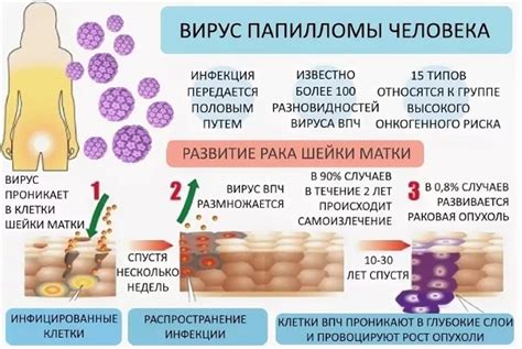 Симптомы ДНК ВПЧ 52