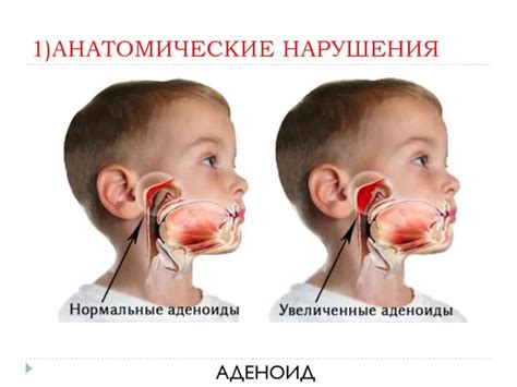 Симптомы аденоидов у детей 3 лет