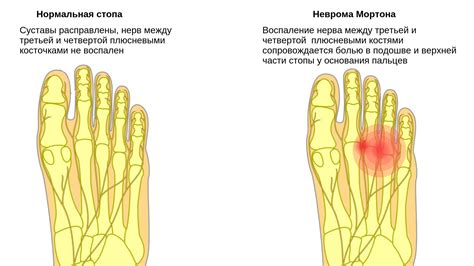 Симптомы боли в подушечках стопы