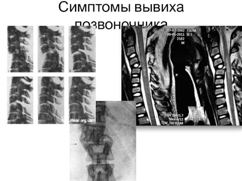 Симптомы вывиха позвоночника