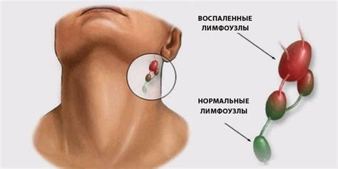 Симптомы гиперплазии коркового слоя лимфоузла