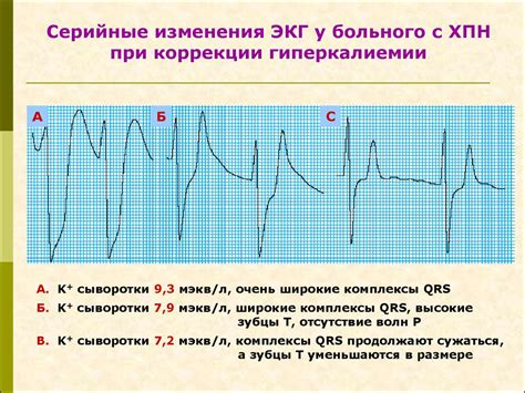 Симптомы и диагностика аномальной ЭКГ