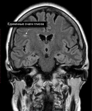 Симптомы и диагностика единичных супратенториальных очагов глиоза