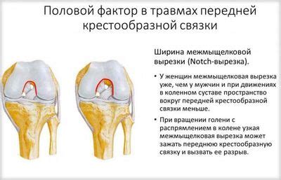 Симптомы и диагностика порванной передней крестообразной связки колена