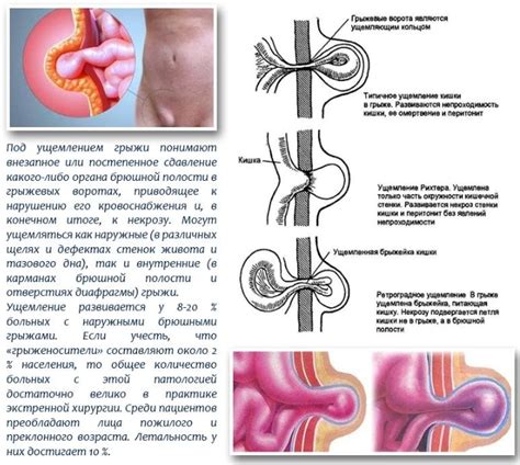 Симптомы и диагностика рупочной грыжи у детей