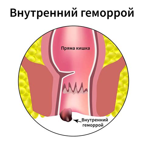 Симптомы и как определить увеличение стомы