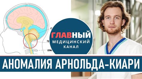 Симптомы и методы лечения синдрома Арнольда-Киари 1 степени