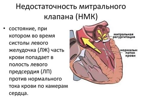 Симптомы и основные проявления недостаточности миокарда и митрального клапана 1 степени