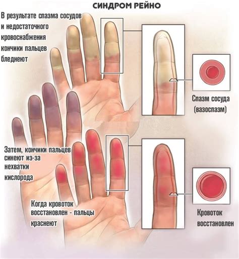 Симптомы и последствия онемения рук