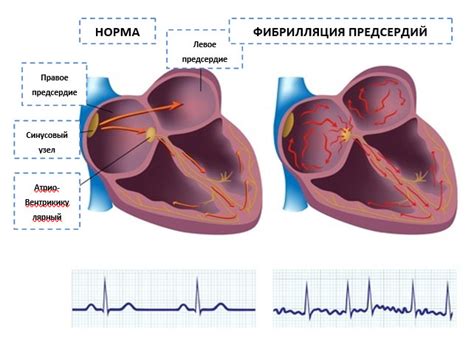 Симптомы и последствия фибрилляции предсердий