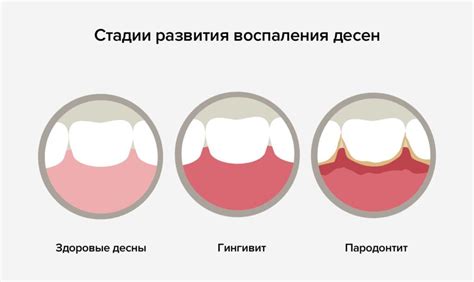 Симптомы и причины воспаления десен