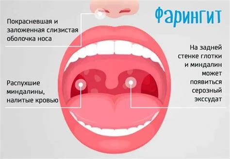 Симптомы и причины фарингита