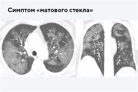 Симптомы многоочагового поражения легких