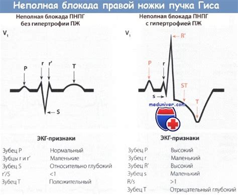 Симптомы неполной блокады на ЭКГ