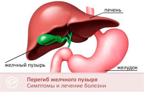 Симптомы перегиба желчного пузыря