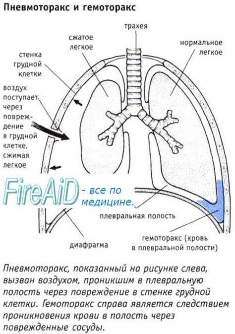 Симптомы пневмоторакса