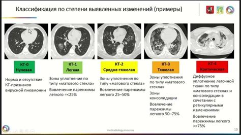 Симптомы поражения легких на 40%