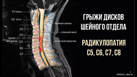 Симптомы ретролистеза с6 шейного отдела