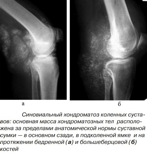 Симптомы суставной сумки коленного сустава