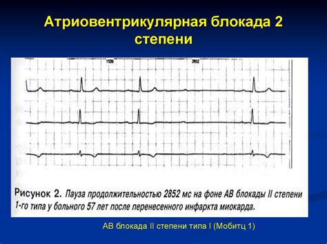 Симптомы транзиторной са блокады 2 степени