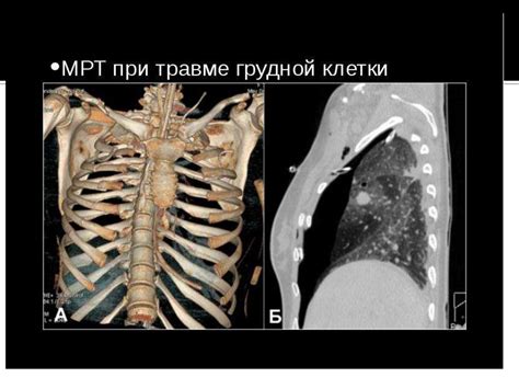 Симптомы трещины в ребре