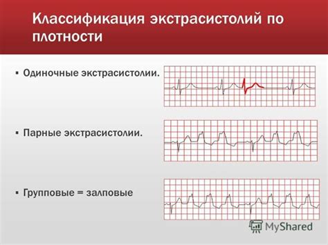 Симптомы экстрасистолии желудочковой