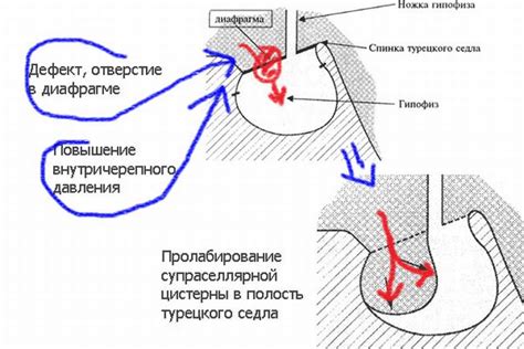 Синдром пустого турецкого седла: симптомы, диагностика, лечение