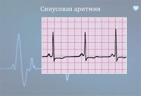 Синусовая аритмия: основные симптомы и причины