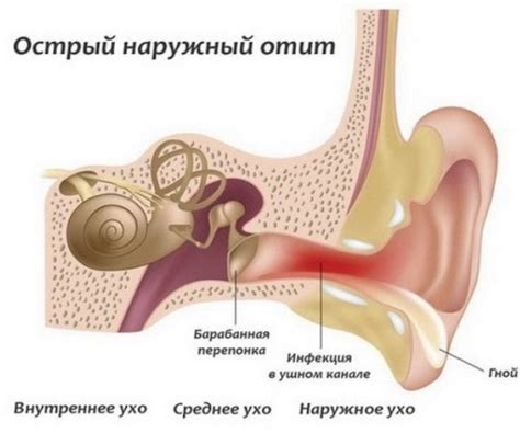 Системное лечение гноящегося уха