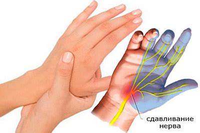 Системные заболевания, вызывающие онемение и потерю чувствительности кистей рук