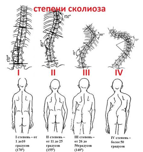 Сколиозы позвоночника