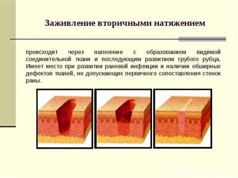 Снижение воспаления и отека